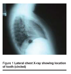 Figure 1 Lateral chest X-ray showing location  of tooth (circled)