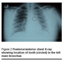 Figure 2 Posterior/anterior chest X-ray  showing location of tooth (circled) in the left  main bronchus