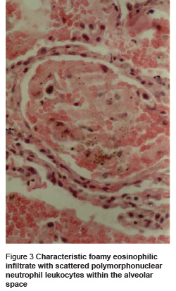 Figure 3 Characteristic foamy eosinophilic infiltrate with scattered polymorphonuclear neutrophil leukocytes within the alveolar space