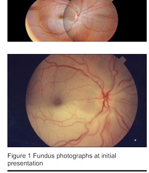 Figure 1 Fundus photographs at initial presentation