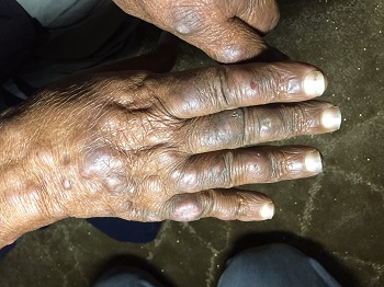 Stamping out leprosy in Libya