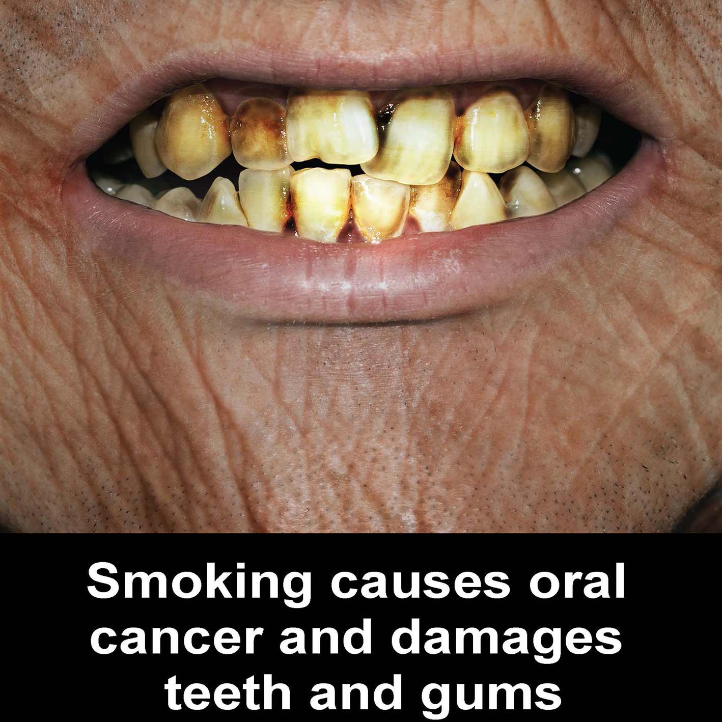 smoking-causes-oral-cancer